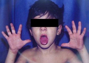 Síntoma Síndrome de Kawasaki