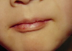 Síntoma Síndrome de Kawasaki