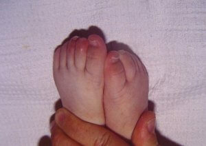 Síntoma Síndrome de Kawasaki