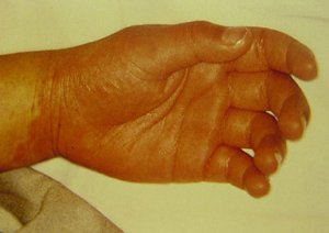 Síntoma Síndrome de Kawasaki