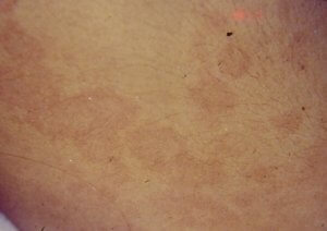 Síntoma Síndrome de Kawasaki