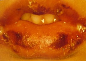 Síntoma Síndrome de Kawasaki