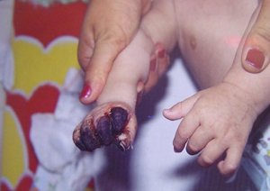 Síntoma Síndrome de Kawasaki