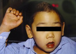 Síntoma Síndrome de Kawasaki